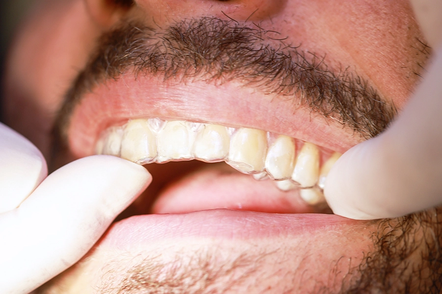 orthodontie dents parfaitement alignées