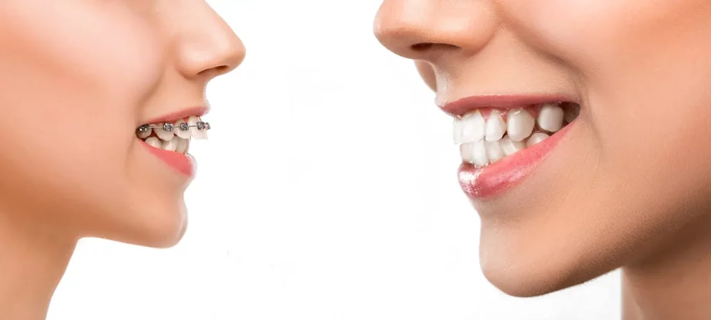 orthodontie dents parfaitement alignées